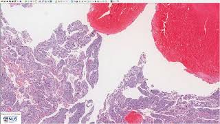 Uterus Choriocarcinoma Microscopy  Talking Slide [upl. by Renick]