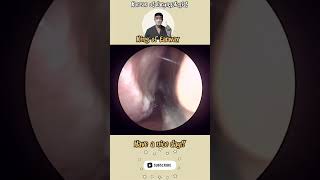 rhinorrhea sinusitis bersihkankuping satisfyingvideos pembersihan telinga video puas hati [upl. by Divadleahcim315]