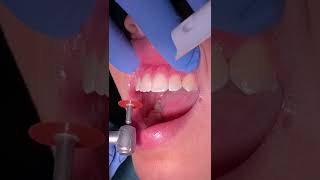 Treatment of periodontal disease  Scaling and root planing  Tartar © [upl. by Ashil]