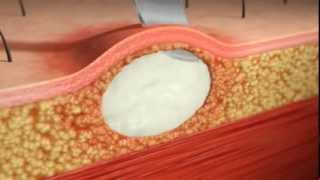 Skin Abscess IampD Animation Injectioncoursescom [upl. by Ahsekim]