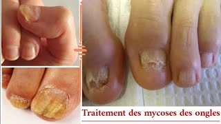 Traite les mycoses des ongles et traite les peaux mortes sous longle [upl. by Duer]