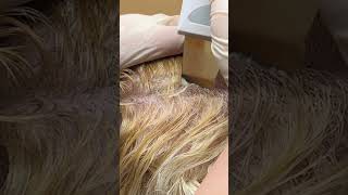 Scalp Treatment for Dandruff Removal [upl. by Oimetra]