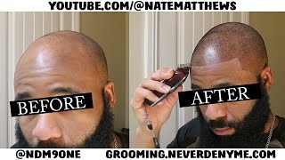 How To Get Your Hairline Back  From Bald To Edge Up  Hairline Restoration [upl. by Anaibaf]