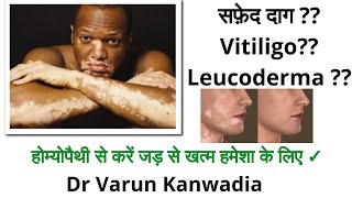 Homeopathy Treatment of Vitiligo  Leucoderma  White Skin  सफ़ेद दाग [upl. by Izogn]