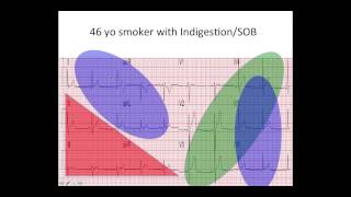 EKG Quiz STEMI or Not [upl. by Yobybab383]