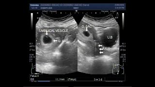 Ultrasound Video showing Early pregnancy with the Mirena a hormonal intrauterine device IUD [upl. by Auqinet]