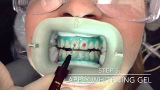 Professional InOffice Teeth Whitening by Mint Dental OC in Yorba Linda Orange County [upl. by Jakob475]