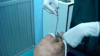 Nasogastric Tube Insertion [upl. by Neeliak]