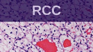 Renal Cell Carcinoma  Pathology mini tutorial [upl. by Charity]