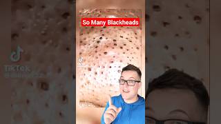 😲Most Blackheads I Have Ever Seen  BLACKHEAD REMOVAL shorts [upl. by Guise]