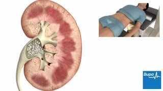 Extracorporeal Shock Wave Lithotripsy ESWL – CIMS Hospital [upl. by Oirevas490]