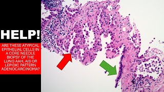 Atypical cells suspicious for adenocarcinoma AAH AIS [upl. by Einallem]