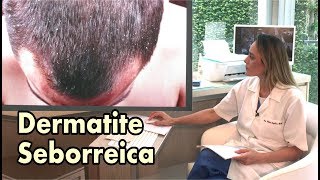 Dermatite Seborreica e Caspa  Conheça as diferenças [upl. by Jaenicke]