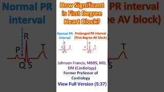 How Significant is First Degree Heart Block [upl. by Nalaf573]