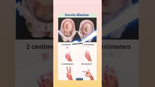 cervix dilation aiims norcet cervixdilation [upl. by Nothgiel922]