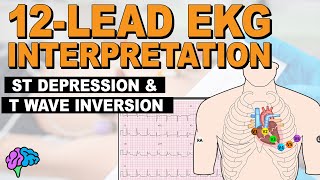 Myocardial Ischemia  ST Depression amp T Wave Inversion  12lead EKG [upl. by Carson80]