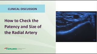 How to Check the Patency and Size of the Radial Artery  Terumo Interventional Systems [upl. by Mayap]