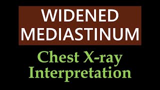 Widened Mediastinum  Chest Xray Interpretation [upl. by Llenart542]