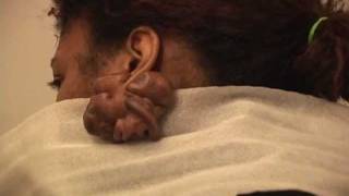 NonSurgical Ear Keloid Treatment [upl. by Aryajay715]