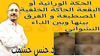 أسرار مرضNotalgia paresthetica المسبب لتصبغات الظهرأعراضأسبابمخاطر الإصابةمضاعفاتتشخيصطرق علاج [upl. by Elletnuahs]