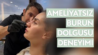 Hastamızın Burun Dolgusu Deneyimi  DrErsin Aydın  Green Klinik [upl. by Ativet115]