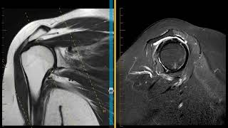 Shoulder impingement with rotator cuff tendinopathy and labral tear [upl. by Lucian]