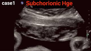 Abruptio Placentae  Ultrasound Basics [upl. by Blakely329]