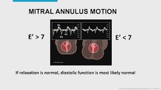 EVALUATION OF DIASTOLIC DYSFUNCTION THE BASICSMAYO CLINIC [upl. by Samuel224]