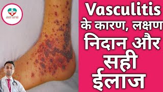 Vasculitis क्या होता है क्यू होता है इसका ईलाज कैसे होता है Vasculitis Hindi [upl. by Ssitruc]