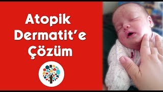 EGZAMADAN KORTİZONSUZ KURTULDUK  Atopik Dermatikten kurtulma yöntemleri [upl. by Audly]