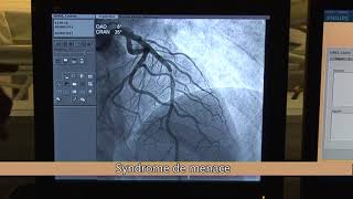 Déroulement dune angioplastie  CCI Nord Est [upl. by Laidlaw]