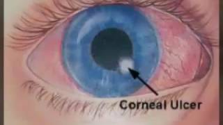 Corneal ulcer [upl. by Artep30]