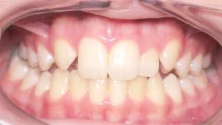 Canine Substitution Missing Lateral Incisor Kyger Orthodontics [upl. by Naesed]