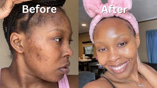 How I Cleared My Acne  Dark Spots  Hyperpigmentation for good in 1 month NO ACCUTANE VIDEO PROOF [upl. by Nylorahs]