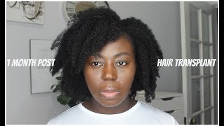 1 Month Post Hair Transplant [upl. by Jacintha]