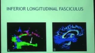 Role of MR DTI amp tractography in neurological diseases [upl. by Soneson]