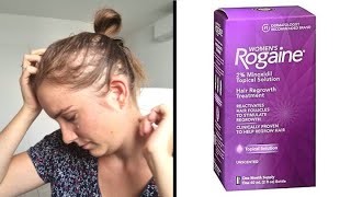 MINOXIDILROGAINE amp ALOPECIA My 10 years treatment experience review [upl. by Brookes]