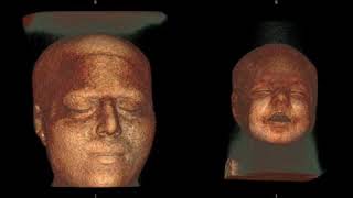 Lissencephal Brain VS normal Brain using MRI [upl. by Lenz]