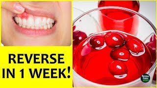 Reverse Receding Gums Naturally In 1 Week [upl. by Ilellan]