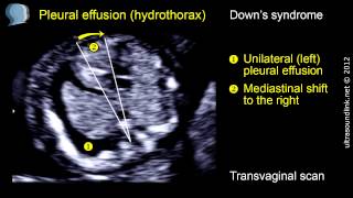 Pleural effusion hydrothorax at 1113 weeks [upl. by Nytsyrk48]