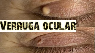 Como remover VERRUGAS oculares [upl. by Noscire]