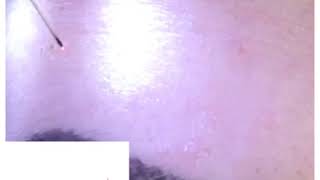 Plasma Skin Rejuventation  Forehead Line Reduction using Plasma Pen Pro [upl. by Richardo]