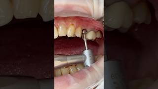 임플란트 세멘리스보철 dental dentist implantdentist cementless [upl. by Kathlene620]