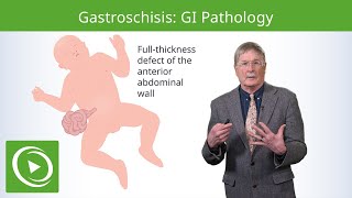 Gastroschisis GI Pathology  Epidemiology Pathophysiology Diagnosis amp Treatment [upl. by Haduhey]