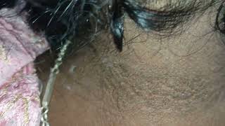 what are disease associated with acanthosis nigricans [upl. by Elak440]