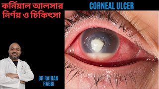 Corneal Ulcer Diagnosis amp Treatment 🔴 কর্নিয়াল আলসার নির্ণয় ও চিকিৎসা  চোখের কর্নিয়ার রোগ [upl. by Xed]