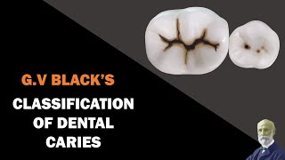 Classification of Dental Caries  GV Blacks Classification [upl. by Fiester90]