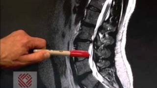 Low Back Pain Part 8 Spinal Stenosis [upl. by Britteny]