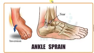 ORTHOPAEDICS Ankle Sprain [upl. by Scuram]