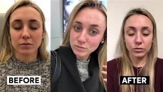 Vivace RF Microneedling Treatment Experience amp Results [upl. by Player]